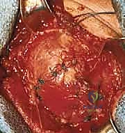 صورة توضيحية لـ إصلاح تمزق الكفة المدورة المفتوح في الكتف: دليل شامل للمرضى مع الأستاذ الدكتور محمد هطيف في صنعاء