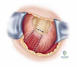 صورة توضيحية لـ إصلاح تمزق الكفة المدورة المفتوح في الكتف: دليل شامل للمرضى مع الأستاذ الدكتور محمد هطيف في صنعاء