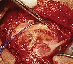 استخدام حمالة الكتف الطبية بعد الجراحة