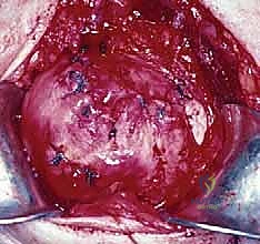 صورة طبية: إصلاح تمزق الكفة المدورة المفتوح في الكتف: دليل شامل للمرضى مع الأستاذ الدكتور محمد هطيف في صنعاء