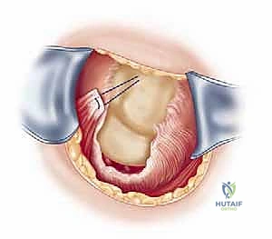 إغلاق الشق الجراحي تجميلياً