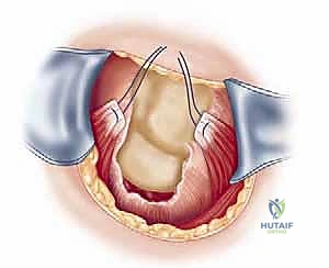 خياطة الوتر الممزق بتقنيات متقدمة