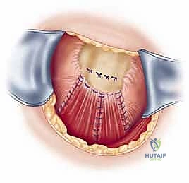 صورة توضيحية لـ إصلاح تمزق الكفة المدورة المفتوح في الكتف: دليل شامل للمرضى مع الأستاذ الدكتور محمد هطيف في صنعاء
