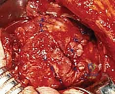 صورة توضيحية لـ إصلاح تمزق الكفة المدورة المفتوح في الكتف: دليل شامل للمرضى مع الأستاذ الدكتور محمد هطيف في صنعاء