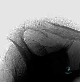 إدخال المنظار واستكشاف مفصل الكتف