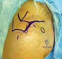 إجراء تجميل الأخرم وإزالة النتوءات العظمية