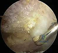 الفحص السريري وتشخيص انحشار الكتف