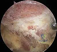 تنظير الكتف لتخفيف الضغط تحت الأخرم وتجميل الأخرم علاج متقدم لانحشار الكتف