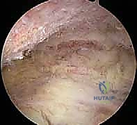 مريض يتعافى ويعود لحياته الطبيعية بعد جراحة الكتف