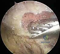 تمارين العلاج الطبيعي وإعادة التأهيل بعد جراحة الكتف