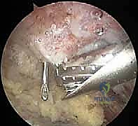 تشريح مفصل الكتف والقوس الغرابي الأخرمي