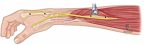 Mastering Percutaneous K-Wire Fixation for Distal Radius Fractures: An Intraoperative Guide