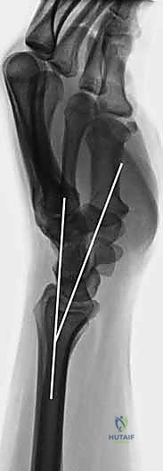 توضيح طبي لأنواع كسور الرسغ