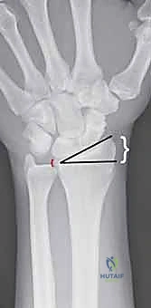 فحص وتقييم كسر الرسغ بالأشعة