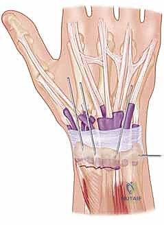 صور الأشعة السينية لكسر الكعبرة