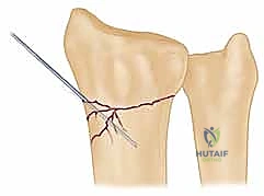 استخدام جهاز الأشعة المرئية C-arm لتحديد مسار السلك