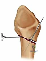 التأكد من استقامة العظم بعد الرد