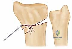 توجيه السلك المعدني الأول بدقة فائقة