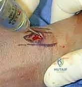 صورة طبية: تثبيت كسر الرسغ بالأسلاك المعدنية: دليل شامل للمرضى مع الأستاذ الدكتور محمد هطيف