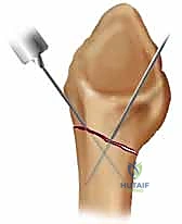 إدخال السلك المعدني عبر الجلد