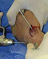 صورة طبية: تثبيت كسر الرسغ بالأسلاك المعدنية: دليل شامل للمرضى مع الأستاذ الدكتور محمد هطيف