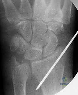 صورة توضيحية لـ تثبيت كسر الرسغ بالأسلاك المعدنية: دليل شامل للمرضى مع الأستاذ الدكتور محمد هطيف