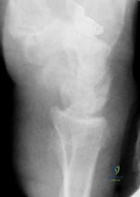 تثبيت كسر الرسغ بالأسلاك المعدنية: دليل شامل للمرضى مع الأستاذ الدكتور محمد هطيف