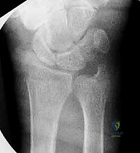 صورة توضيحية لـ تثبيت كسر الرسغ بالأسلاك المعدنية: دليل شامل للمرضى مع الأستاذ الدكتور محمد هطيف