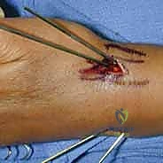 صورة توضيحية لـ تثبيت كسر الرسغ بالأسلاك المعدنية: دليل شامل للمرضى مع الأستاذ الدكتور محمد هطيف