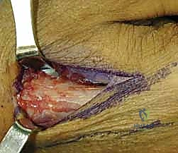 صورة طبية: تثبيت كسر الرسغ بالأسلاك المعدنية: دليل شامل للمرضى مع الأستاذ الدكتور محمد هطيف