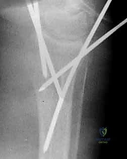 صورة طبية: تثبيت كسر الرسغ بالأسلاك المعدنية: دليل شامل للمرضى مع الأستاذ الدكتور محمد هطيف