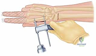 صورة توضيحية لـ تثبيت كسر الرسغ بالأسلاك المعدنية: دليل شامل للمرضى مع الأستاذ الدكتور محمد هطيف