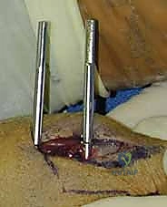 صورة توضيحية لـ تثبيت كسر الرسغ بالأسلاك المعدنية: دليل شامل للمرضى مع الأستاذ الدكتور محمد هطيف