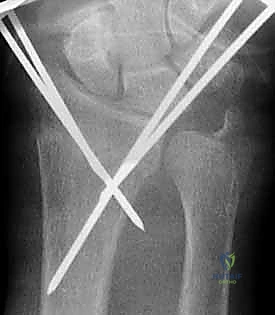 صورة توضيحية لـ تثبيت كسر الرسغ بالأسلاك المعدنية: دليل شامل للمرضى مع الأستاذ الدكتور محمد هطيف