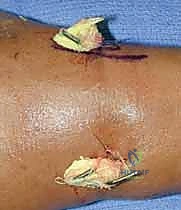 صورة توضيحية لـ تثبيت كسر الرسغ بالأسلاك المعدنية: دليل شامل للمرضى مع الأستاذ الدكتور محمد هطيف