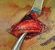 صورة طبية: تثبيت كسر الرسغ بالأسلاك المعدنية: دليل شامل للمرضى مع الأستاذ الدكتور محمد هطيف