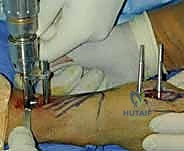 صورة طبية: تثبيت كسر الرسغ بالأسلاك المعدنية: دليل شامل للمرضى مع الأستاذ الدكتور محمد هطيف