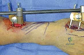 صورة طبية: تثبيت كسر الرسغ بالأسلاك المعدنية: دليل شامل للمرضى مع الأستاذ الدكتور محمد هطيف