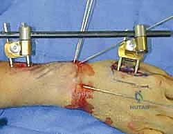 صورة طبية: تثبيت كسر الرسغ بالأسلاك المعدنية: دليل شامل للمرضى مع الأستاذ الدكتور محمد هطيف