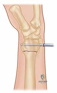 صورة طبية: تثبيت كسر الرسغ بالأسلاك المعدنية: دليل شامل للمرضى مع الأستاذ الدكتور محمد هطيف