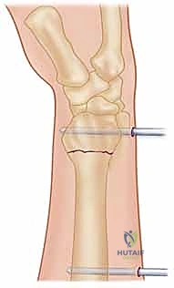 صورة طبية: تثبيت كسر الرسغ بالأسلاك المعدنية: دليل شامل للمرضى مع الأستاذ الدكتور محمد هطيف