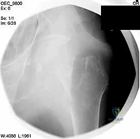مرحلة التوسيع المتقدمة