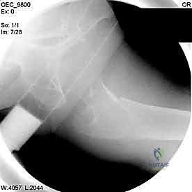 تجهيز المسمار النهائي