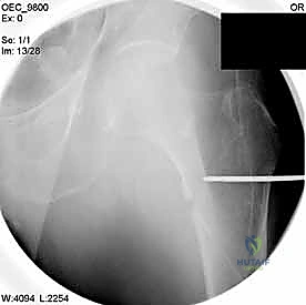 توجيه المسمار داخل عنق الفخذ