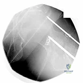 تأكيد ثبات المسمار المنزلق