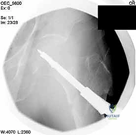 تأكيد مسار السلك الدليلي بالأشعة
