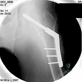 اللمسات الأخيرة لتثبيت العظم