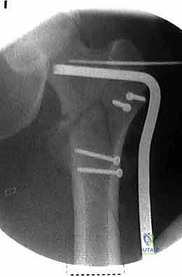 لقطة للمجال الجراحي أثناء الإغلاق