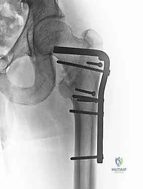 إدخال المسامير الجانبية للتثبيت