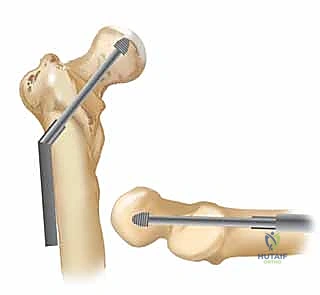 صورة أشعة توضح دقة المحاذاة